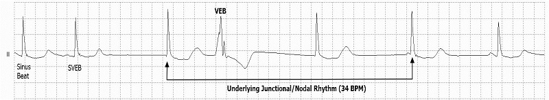 Nodal (A-V junctional) rhythm Rhythm Strip